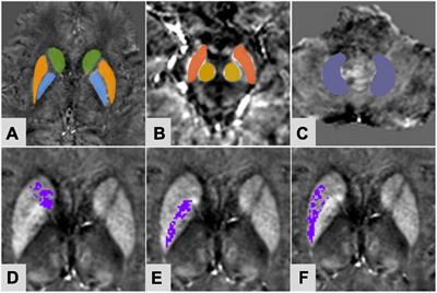 Iron deposition heterogeneity in extrapyramidal system assessed by quantitative susceptibility mapping in Parkinson’s disease patients with type 2 diabetes mellitus